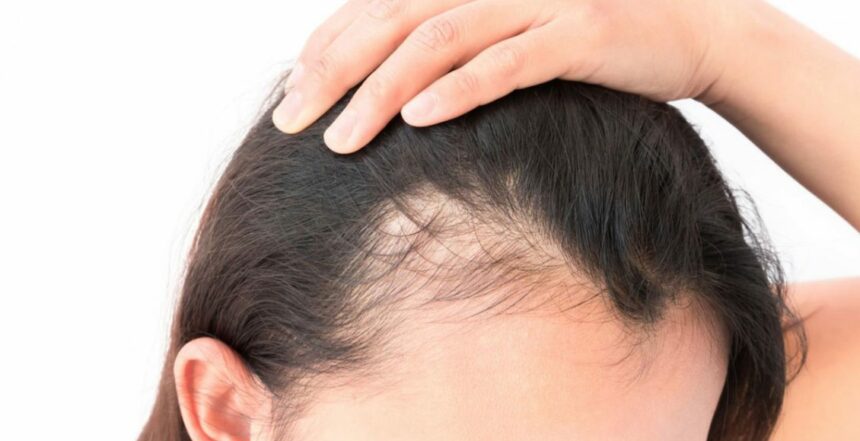 أفضل علاج لتساقط الشعر عند النساء