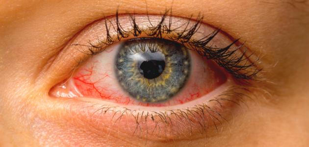 الأمراض التي تصيب العين