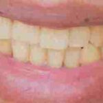 سبب اصفرار الأسنان رغم التنظيف