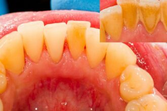طرق إزالة الجير من الأسنان سهلة وبسيطة