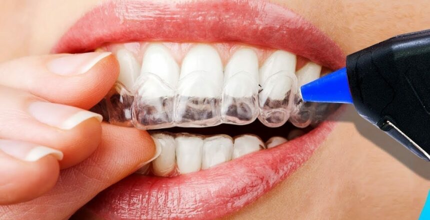 طريقة تركيب أسنان الزيركون