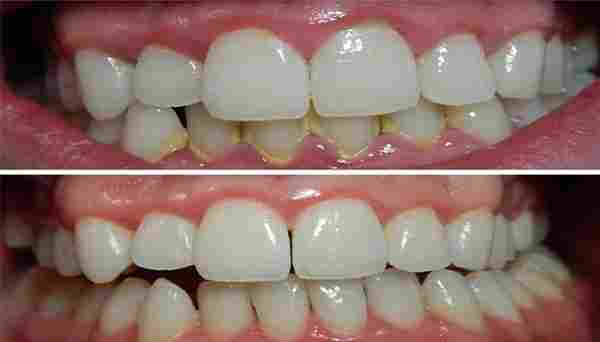 علاج اصفرار الأسنان والجير
