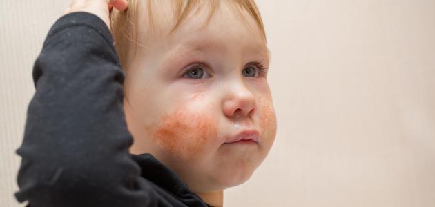 علاج الطفح الجلدي عند الأطفال بالأعشاب