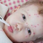 علاج الطفح الجلدي عند الأطفال بعد الحمى