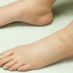 علاج تورم القدمين عند كبار السن بالاعشاب