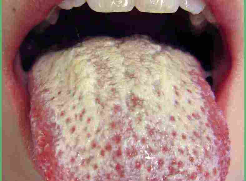 علاج فطريات الفم بالأعشاب