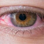 أسباب ظهور عروق حمراء في بياض العين