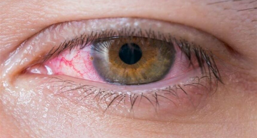 أسباب ظهور عروق حمراء في بياض العين