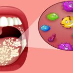 أسباب فطريات الفم المتكررة