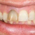 علاج تسوس الأسنان الأمامية في المنزل