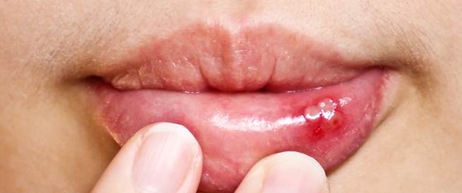 علاج فطريات الفم في المنزل عند الأطفال