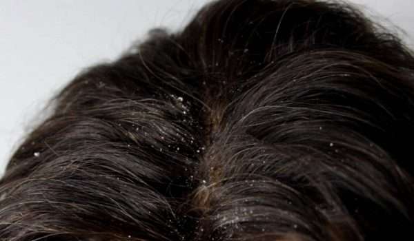 علاج قشرة الشعر بالخل مجرب
