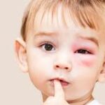 علاج كدمات العين عند الأطفال 