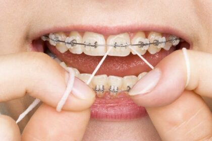كم مدة تقويم الأسنان الأمامية