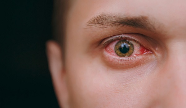 علاج بقعة دم في بياض العين بسبب ضربة