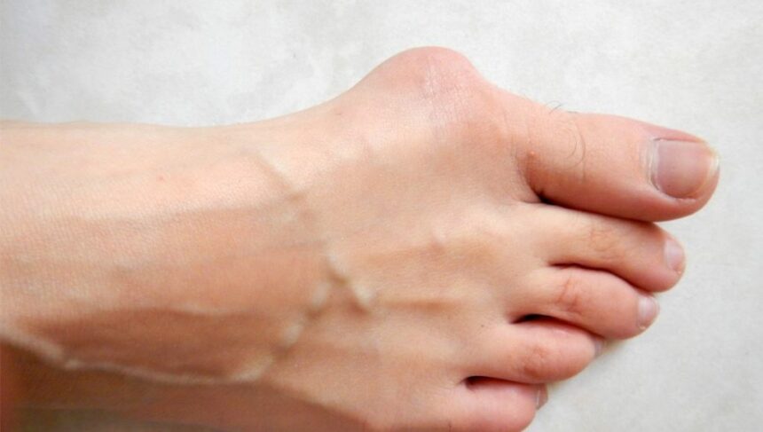 علاج تورم أصابع القدم بسبب الحذاء