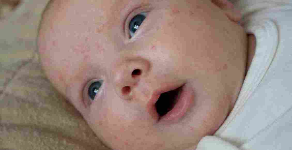 أسباب ظهور حبوب بيضاء على وجوه حديثى الولادة وعلاجها