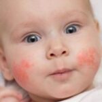 أشهر 8 أمراض جلدية تصيب الرضع وطرق علاجها