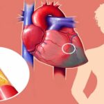 أعراض الأزمة القلبية عند النساء وأسبابها وعلاجها