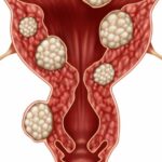 اعراض الورم الليفي في الرحم