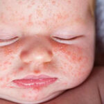 الفرق بين حساسية الحليب وحساسية اللاكتوز عند الرضع