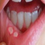 علاج الحمو داخل الفم بطرق طبيعية