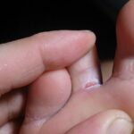 علاج الفطريات بين أصابع القدم