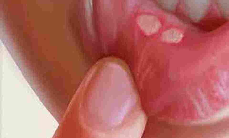علاج تقرحات الفم بالعسل