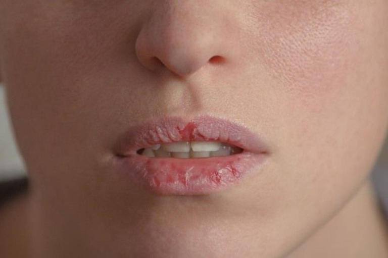 ما هي أسباب جفاف الفم وعلاجه؟