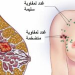 مواصفات الكتلة السرطانية في الثدي
