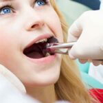 هل خلع الضرس يؤثر على باقي الأسنان؟